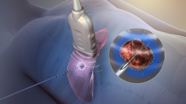 Radiofrequency Ablation (RFA) - Laser Pain Center