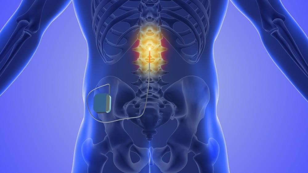 Spinal Cord Stimulation