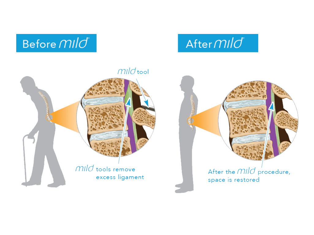 Mild-Procedure-1024x768b