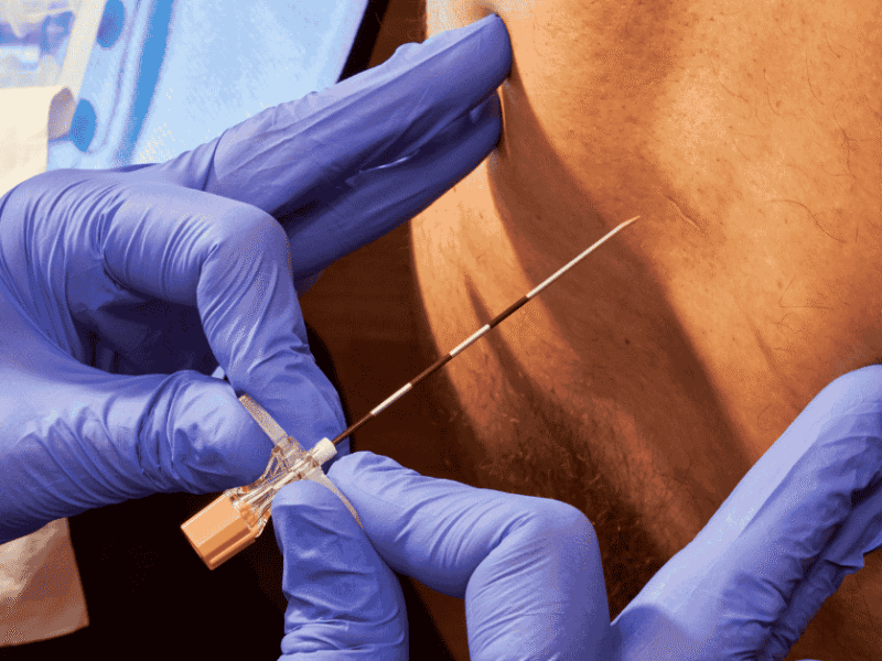 Epidural Steroid Injections for Back Pain: Are They Worth It?