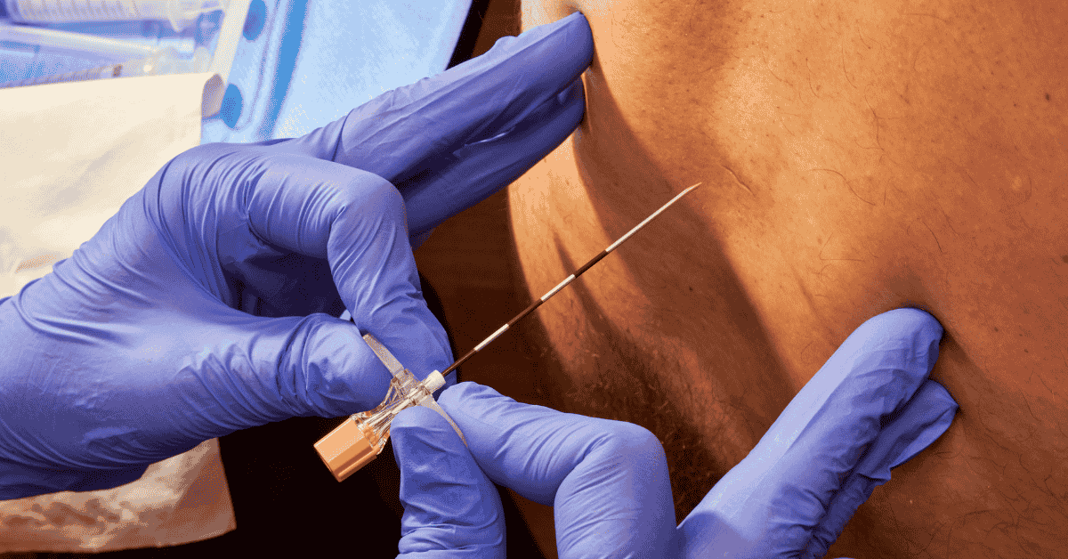 Epidural Steroid Injections for Back Pain: Are They Worth It?